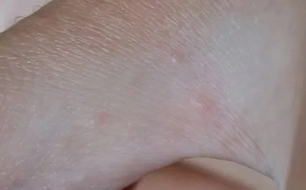 Allergiás ezüst fotó, okok, kezelés, abba allergia