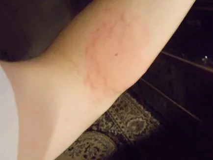 Allergiás ezüst diagnosztizálás, kezelés, megelőzés (allergia) Allergiás ezüst diagnosztizálás, kezelés, megelőzés