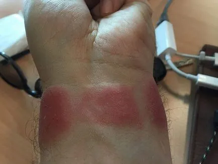 Allergiás ezüst diagnosztizálás, kezelés, megelőzés (profilaxis) Allergiás ezüst diagnosztizálás, kezelés, megelőzés