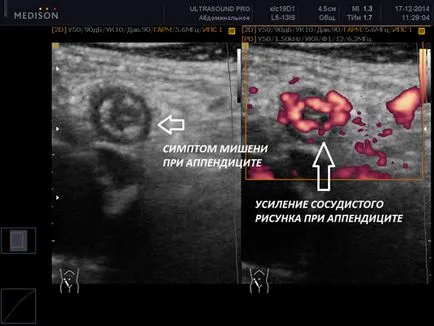 Vakbélgyulladás Ultrahang diagnosztika vakbélgyulladás