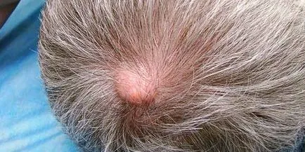 Atheroma - kezelés otthon, anélkül, hogy a kiutasítás végrehajtása népi jogorvoslati és kenőcsök (eltávolítás) Atheroma - kezelés otthon, anélkül, hogy a kiutasítás végrehajtása népi jogorvoslati és kenőcsök
