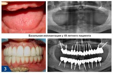 Bazális implantátumok - áttekinti a előnyeiről és hátrányairól, az ár 2017 (implantáció) Bazális implantátumok - áttekinti a előnyeiről és hátrányairól, az ár 2017
