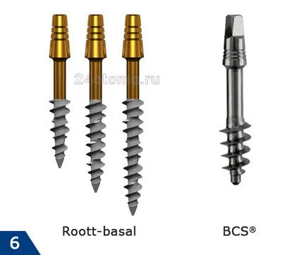 Bazális implantátumok - áttekinti a előnyeiről és hátrányairól, az ár 2017 (bazális implantáció Budapest) Bazális implantátumok - áttekinti a előnyeiről és hátrányairól, az ár 2017
