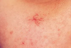 A veszélyesebb hormonális kenőcsök és krémek az arc javallatok mellékhatásokat,