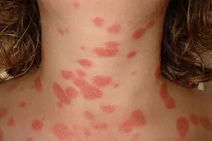 Psoriasis prognózis, kezelés, diagnózis, a tünetek (psoriasis psoriasis) Psoriasis prognózis, kezelés, diagnózis, a tünetek