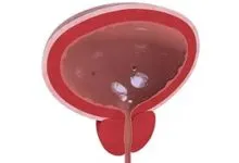 cystectomia mi