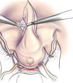 cystectomia mi cystectomia mi