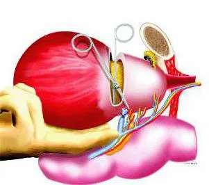 cystectomia mi cystectomia mi
