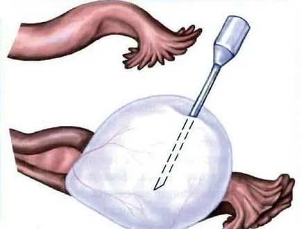 cystectomia mi