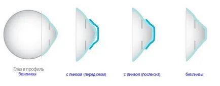 Milyen okai vannak a myopia szem tünetei és kezelése különböző fokú (myopia) Milyen okai vannak a myopia szem tünetei és kezelése különböző mértékű