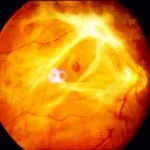 Diabéteszes retinopátia tünetek, kezelés, okai