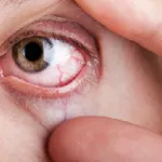 Diabéteszes retinopátia tünetek, kezelés, okai