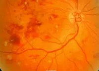 Diabéteszes retinopátia - okai, tünetei, diagnózisa és kezelése