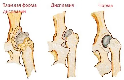 Csípőficam gyermekek fotó, kezelés következményeit TPA
