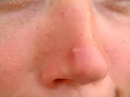 Ha ugrott pattanás az orron vagy az orr jelek