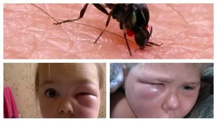 Ha megharapott egy szúnyogot a szem a felnőtt vagy gyermek, mit kell tenni