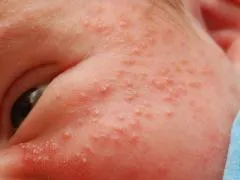 Hormonális kiütés az újszülött, hogy tegye
