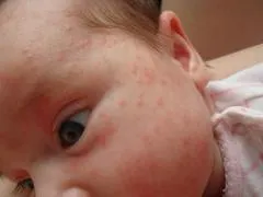 Hormonális kiütés az újszülött, hogy tegye
