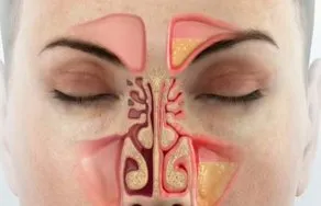 Gennyes bronchitis tünetek, kezelés (antibiotikumok, népi Sze-Wah) (tünetek) Gennyes bronchitis tünetek, kezelés (antibiotikumok, népi Sze-Wah)
