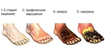 Diabetikus lábápoló