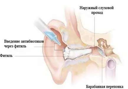 Melyik antibiotikumokra van szükség gyermekek otitis legjobb gyógyszereket venni