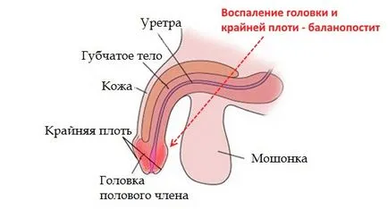Hogyan kell kezelni balanoposthitis otthon