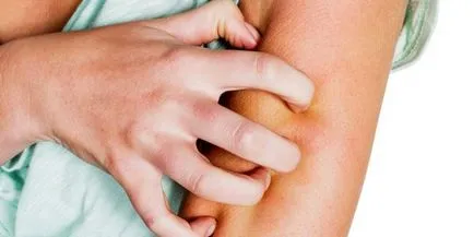 Például a pikkelysömör kezdődik - az első jelei A foltok megjelenése, a tünetek és okok (psoriasis) Például a pikkelysömör kezdődik - az első jelei A foltok megjelenése, tünetei és okai