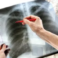 Hogyan lehet azonosítani a tuberkulózis otthon az első jelei és tünetei
