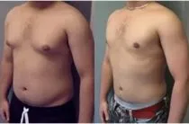 phimosis kezelése népi jogorvoslat