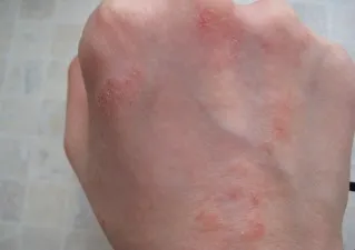 bőrgyulladás kezelésére a kezében