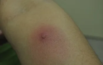Kezelés furuncle (chiriya) az otthoni kenőcsök, antibiotikumok, népi jogorvoslati (feltételek) forralni kezelés (chiriya) otthon kenőcsök, antibiotikumok, népi jogorvoslati