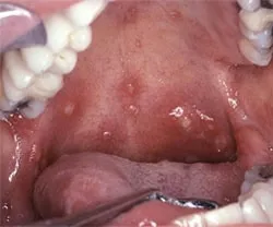 stomatitis kezelésére felnőtteknél milyen gyorsan gyógyítja
