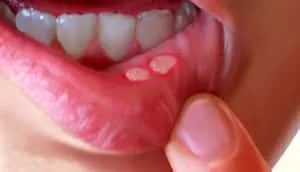 stomatitis kezelésére felnőtteknél milyen gyorsan gyógyítja