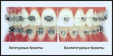 Ligatúra és bezligaturnye zárójelek (ligatúra) Ligatúra és bezligaturnye fogszabályozó