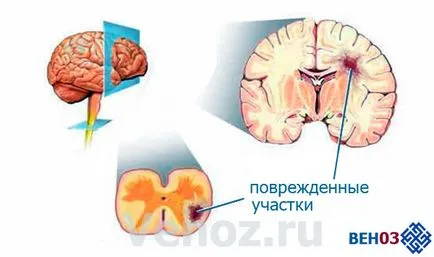 A sclerosis multiplex kezelésére gyógyszerek