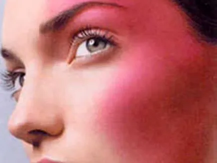A rosacea kezelésének az arcon otthon fényképek, értékelések teljesítménynövelő szerek