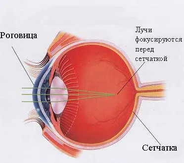 Myopia (rövidlátás) ok, korrekciós kezelés