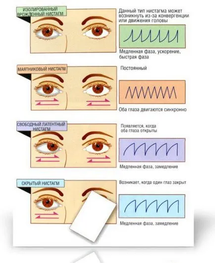 Nystagmus szem, amelyek tünetei, okai és kezelése a betegség