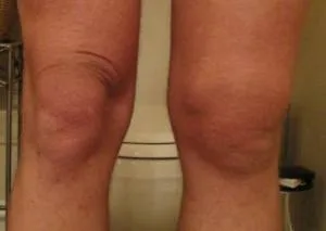 A duzzadási Arthritis - okok és a kezelés (min kezelések száma) Duzzanat arthritis - okok és a kezelés