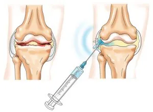 A duzzadási Arthritis - okok és a kezelés (min kezelések száma) Duzzanat arthritis - okok és a kezelés
