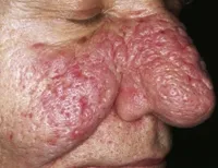 Rosacea - okai, tünetei, diagnózis és kezelés (ok) Rosacea - okai, tünetei, diagnózisa és kezelése