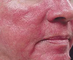 Rosacea - okai, tünetei, diagnózis és kezelés (diagnosztika) Rosacea - okai, tünetei, diagnózisa és kezelése
