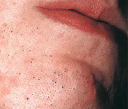 Rosacea - okai, tünetei, diagnózis és kezelés (diagnosztika) Rosacea - okai, tünetei, diagnózisa és kezelése