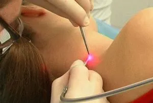 Papilloma a nyak, test, hóna alatt és az arc, hogyan lehet megszabadulni (egér) Papilloma a nyak, test, hóna alatt és az arc, hogyan lehet megszabadulni