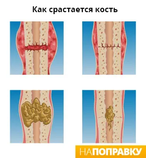 Törött láb tünetek és a kezelés - napopravku
