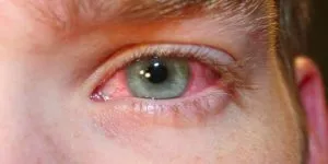 szemen belüli nyomás mérő készülék az otthoni módszerek előírások eltérései (eszköz) a szemen belüli nyomást mérő eszközt az otthoni módszerek standard deviáció