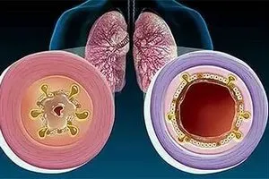 Készítmények a krónikus bronchitis felnőtteknél (felnőtt) Készítmények a krónikus bronchitis felnőtteknél