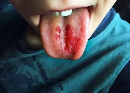 A nyelve, mint kezelni, hogyan kell kezelni a kialakulását sebek, duzzanatok