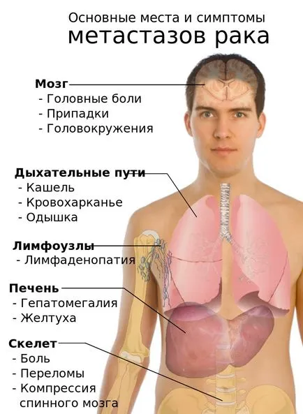 Tüdőrák tünetei, a fő módszerek a diagnózis, a kezelés, megelőzés, prognózis (tünetek) Tüdőrák tünetei, a fő módszerek a diagnózis, a kezelés, megelőzés, prognózis