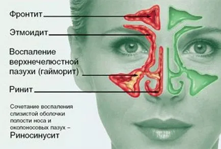 Rhinosinusitis - okok, jelek, tünetek, és a kezelés (kezelés) Rhinosinusitisben - okok, tünetek, tünetei és kezelése
